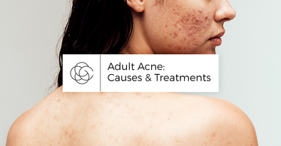 Adult Acne: Causes & Treatments