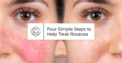 Four Simple Steps to Help Treat Rosacea
