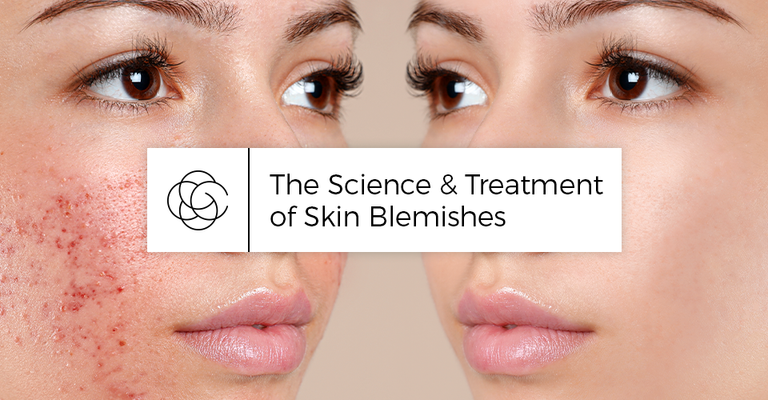 The Science & Treatment of Skin Blemishes