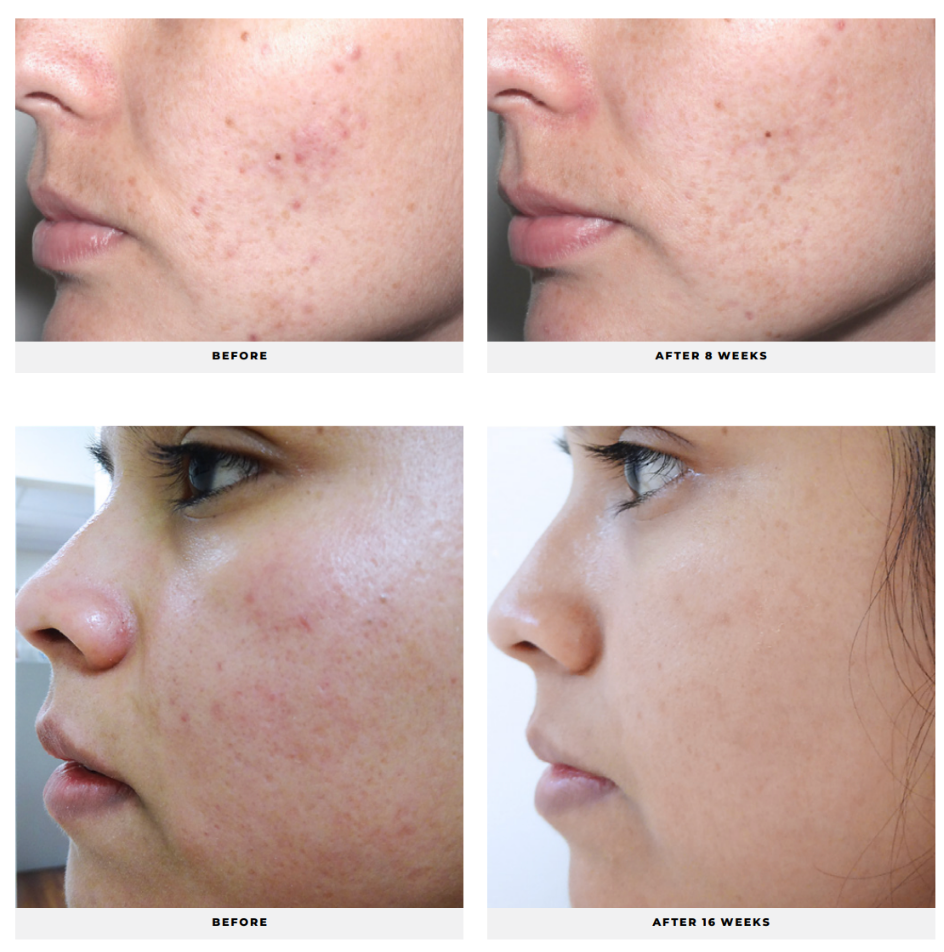Acne Control System