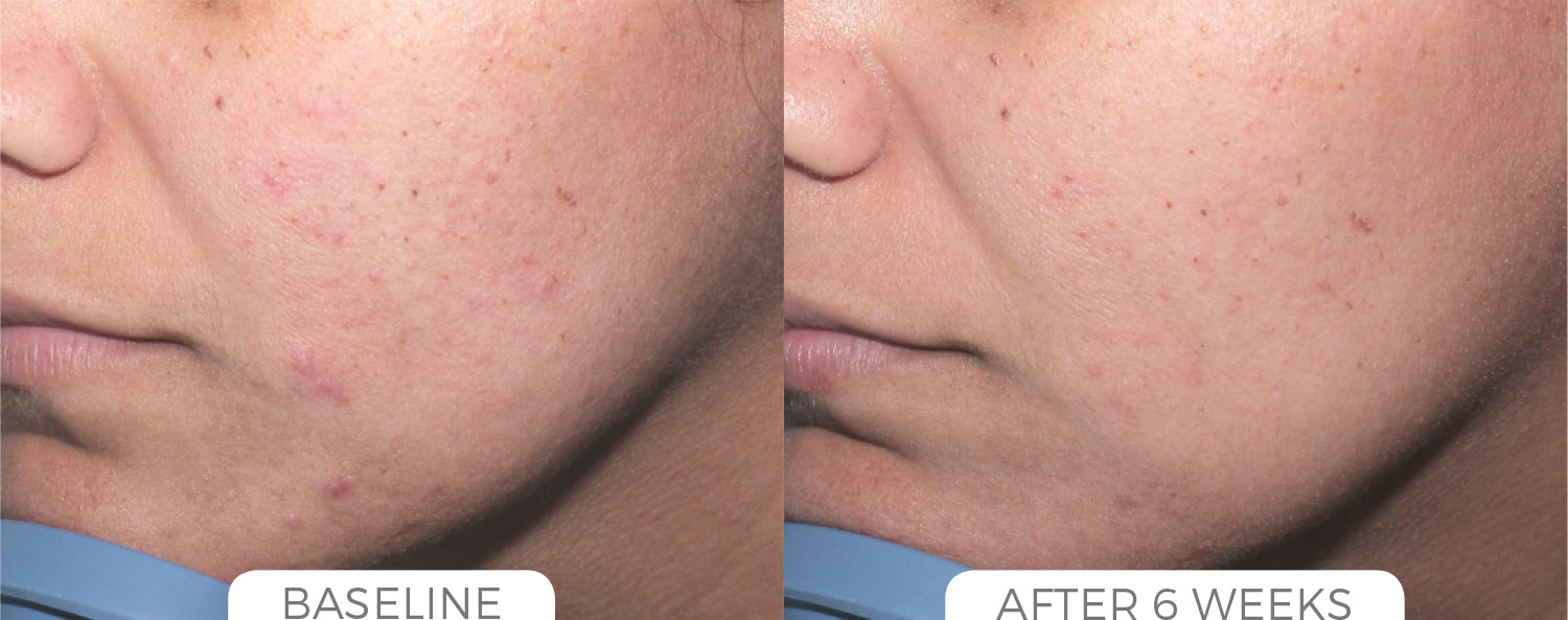 Acne Control System - CosMedical Technologies