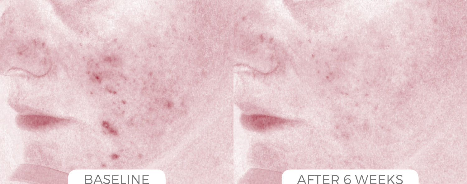 Acne Control System - CosMedical Technologies