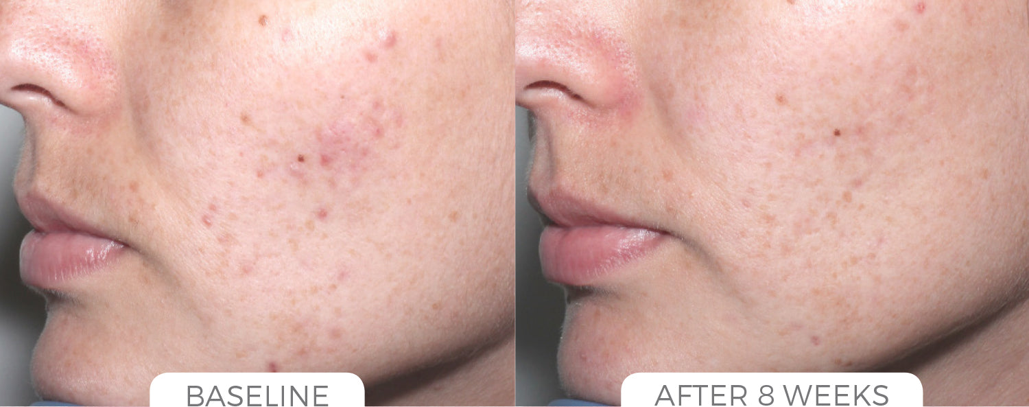 Acne Control System - CosMedical Technologies