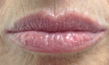 Lip Benefits® - 7.3 ML - CosMedical Technologies