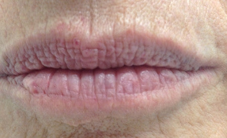 Lip Benefits® - 7.3 ML - CosMedical Technologies