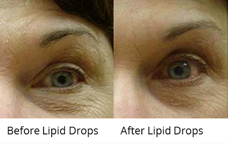 Lipid Drops - CosMedical Technologies