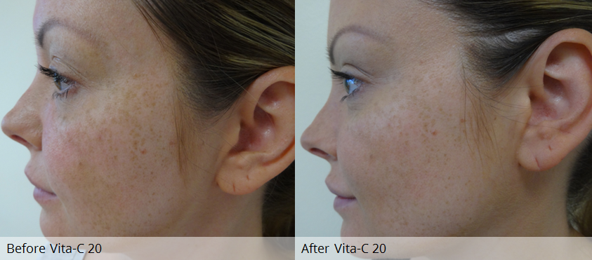 Vita-C 20 - CosMedical Technologies